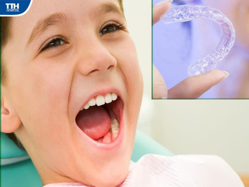 Những lợi ích khi niềng răng trong suốt cho trẻ