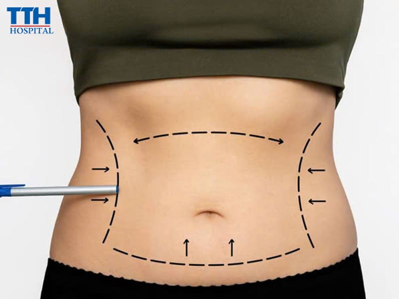Những rủi ro có thể gặp khi hút mỡ toàn thân