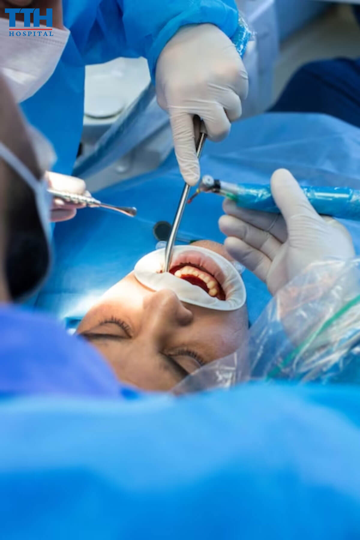 Những trường hợp cần nhổ răng khi niềng răng tại vinh nghệ an