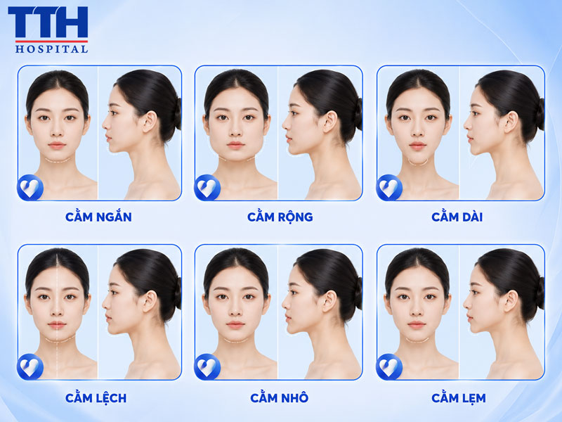 Những trường hợp thường phù hợp với phẫu thuật tạo hình cằm
