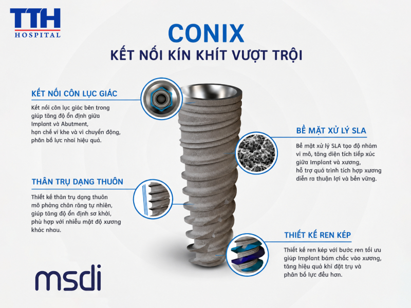 Những ưu điểm vượt trội của trụ Implant Conix