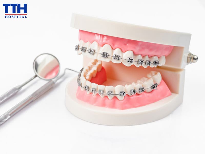 NIỀNG RĂNG LÀ GÌ?