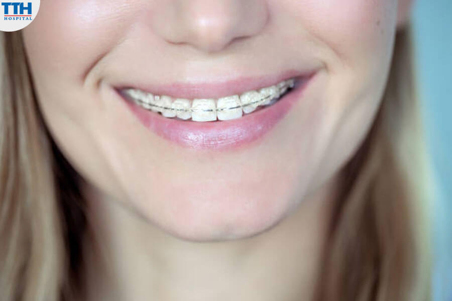 Niềng Răng Mắc Cài Tự Buộc Bằng Sứ Pha Kim Loại