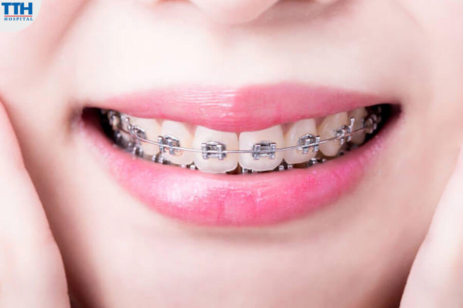 Niềng Răng Mắc Cài Tự Buộc Kim Loại