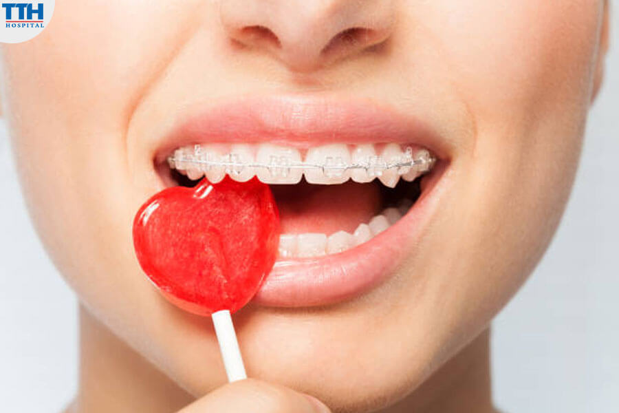 Niềng Răng Mắc Cài Tự Buộc Sứ