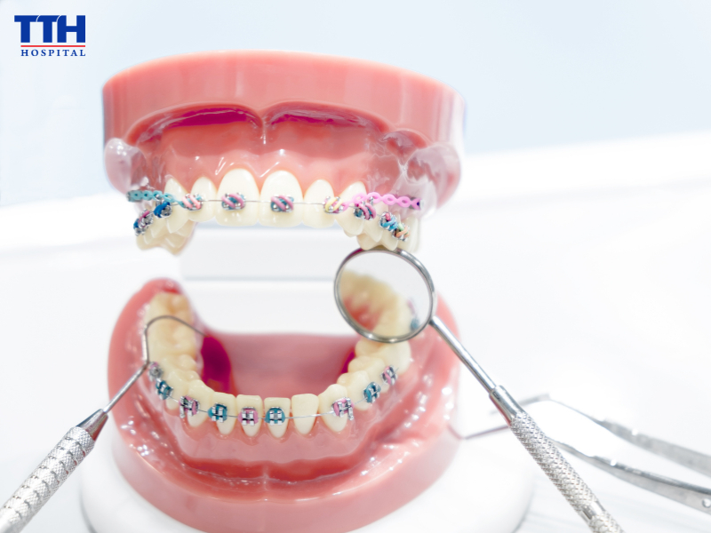 Niềng răng nên hạn chế những thực phẩm nào?
