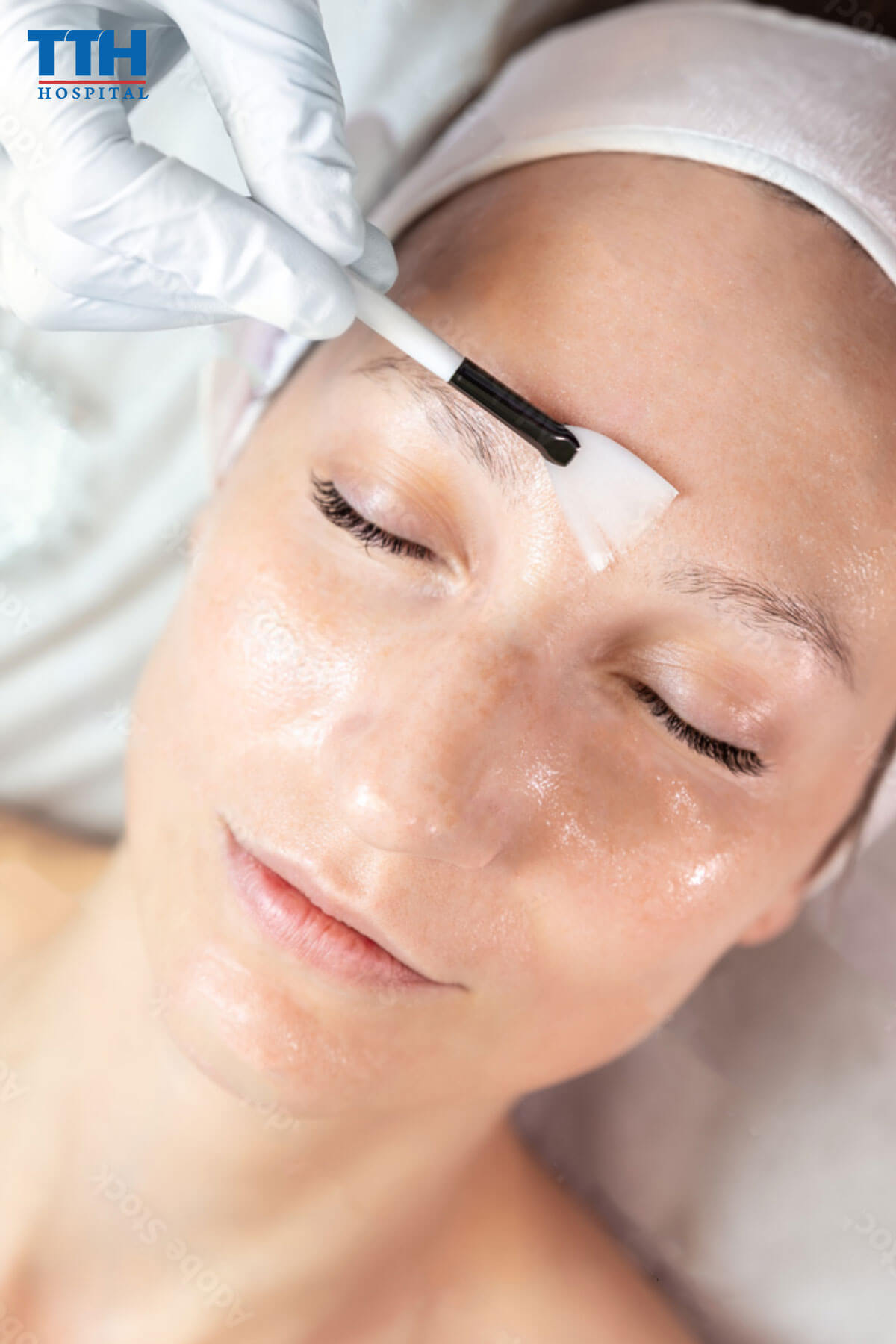 Peel Da Là Gì tại Vinh, nghệ an