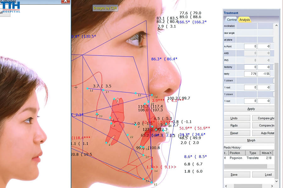 Phần Mềm Hỗ Trợ Niềng Răng VCEPH 3D