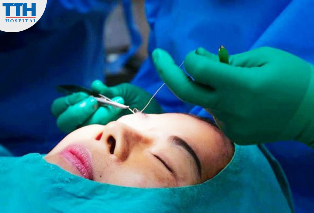 Cân Nhắc Trước Khi Cắt Mí Mắt