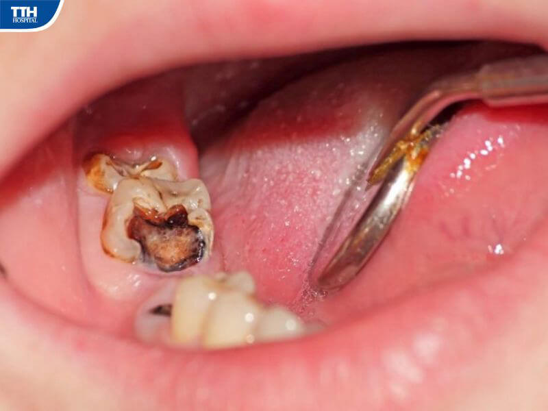 Phòng ngừa viêm tủy răng như thế nào?
