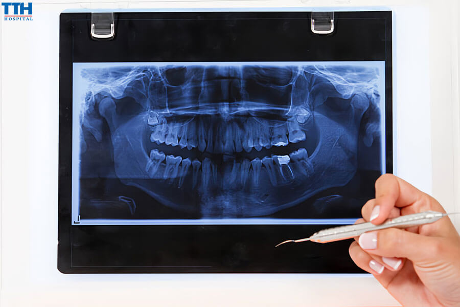 Phương Pháp Chẩn Đoán Áp Xe Tủy Răng