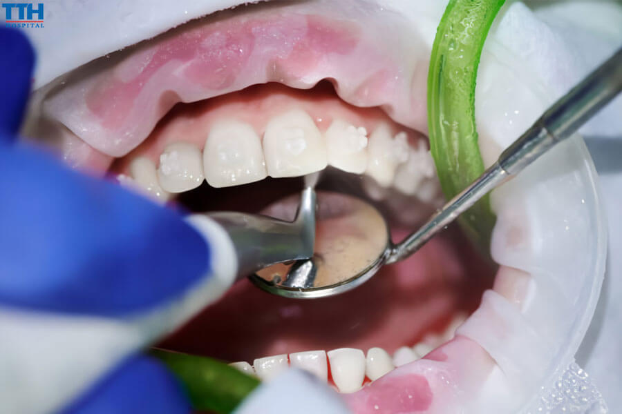 Phương Pháp Điều Trị Hoại Tử Tủy Răng