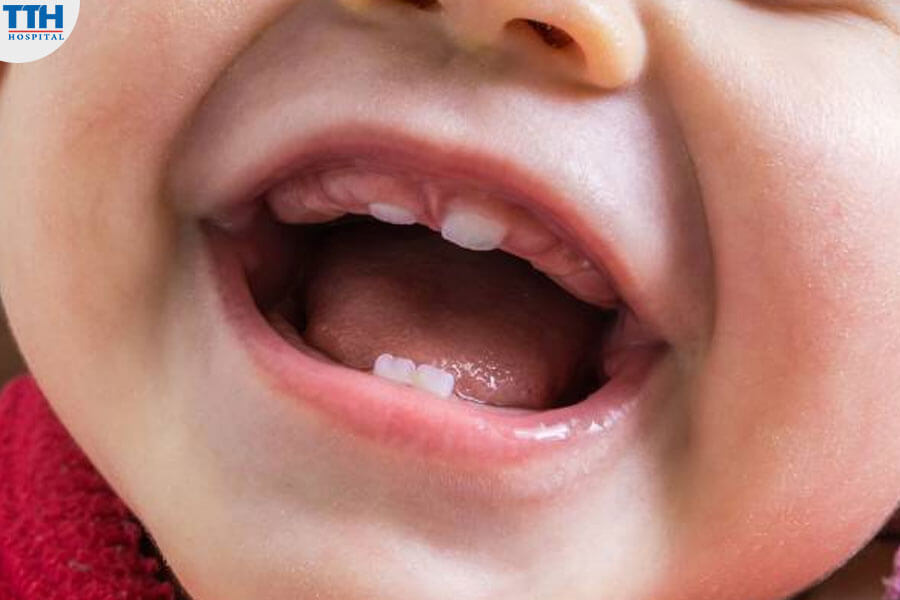 Quá Trình Mọc Răng Sữa