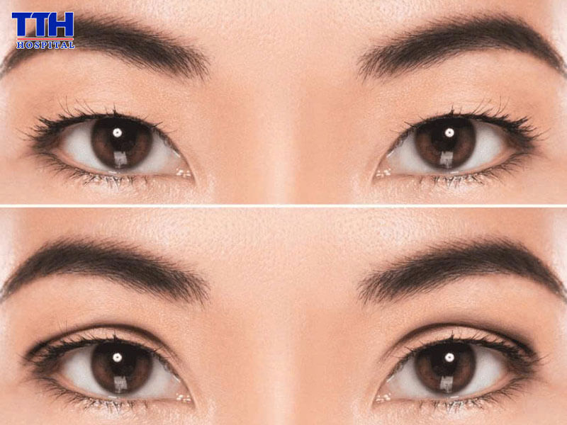 Quy trình cắt mí chuẩn y khoa tại Bệnh viện Thái Thượng Hoàng