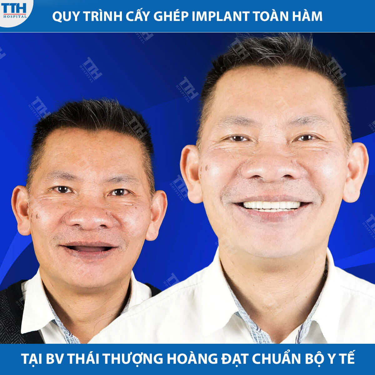 quy trình cấy ghép implant toàn hàm tại bệnh viện Thái Thượng Hoàng