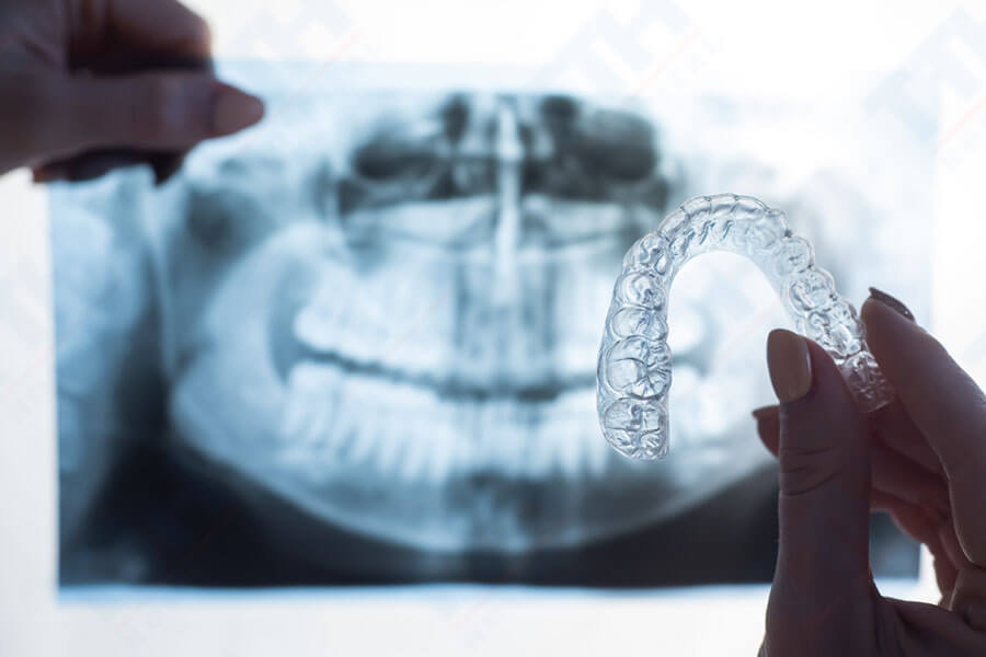 Quy trình nắn chỉnh với TTH Aligners