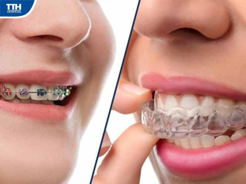 Quy trình niềng răng khớp cắn ngược