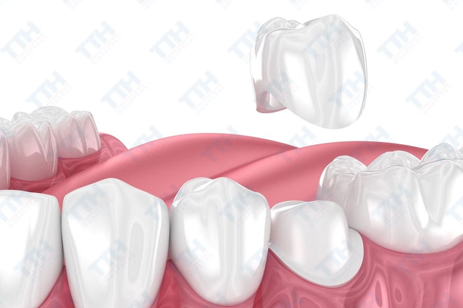 Quy trình thực hiện bọc răng sứ Orodent