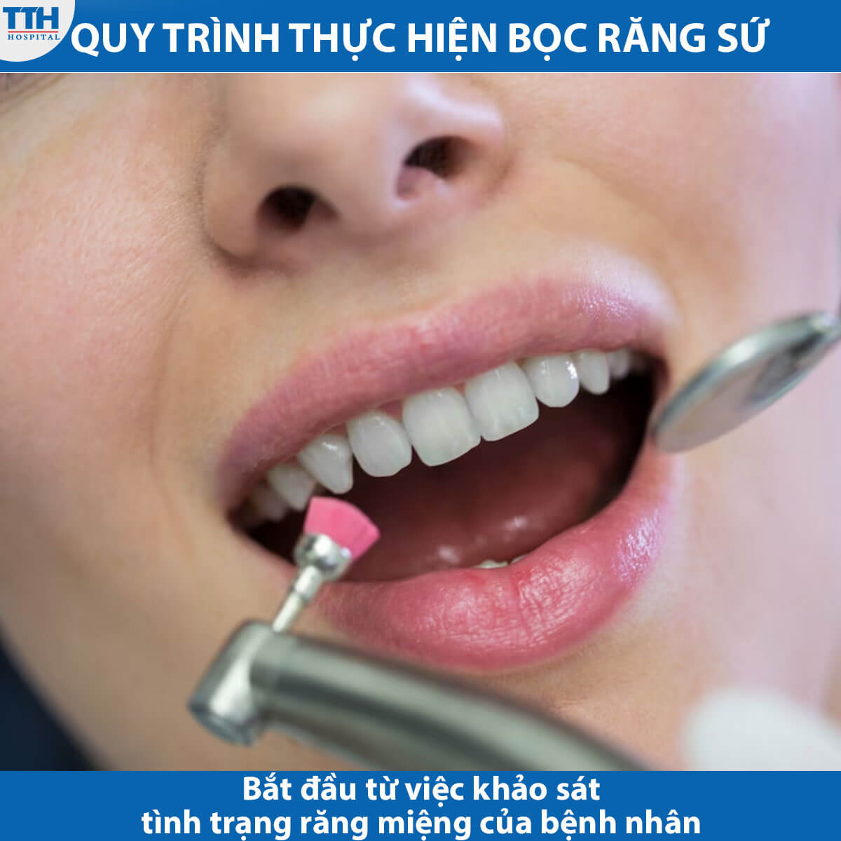Quy trình thục hiện bọc răng sứ