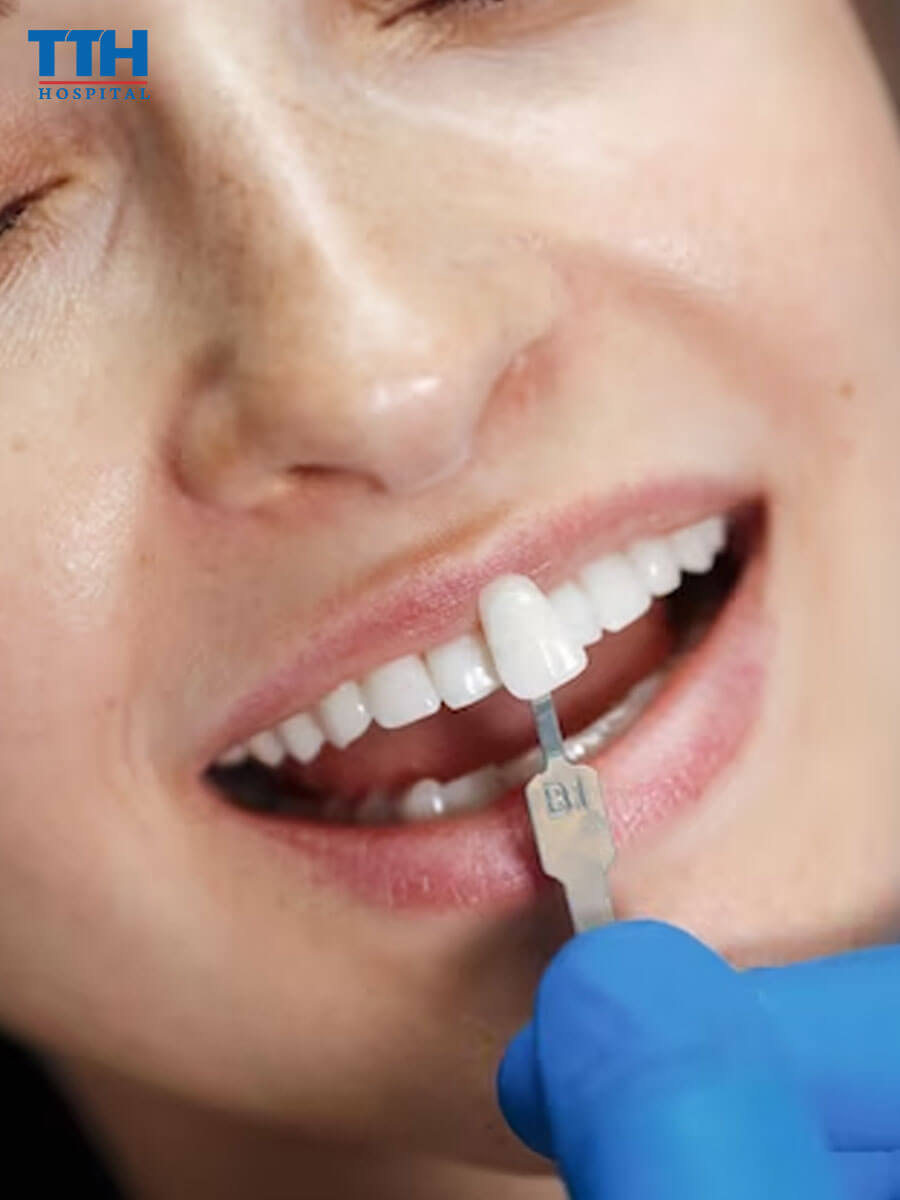 Quy trình thực hiện dán răng sứ Diamond Veneer
