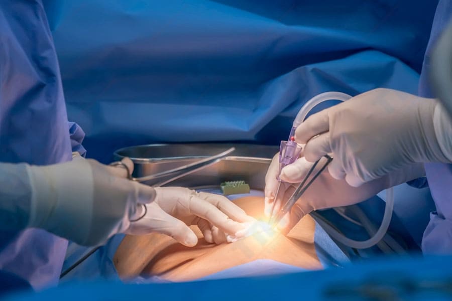 Quy Trình Thực Hiện Phương Pháp Tạo Hình Bụng Sáu Múi