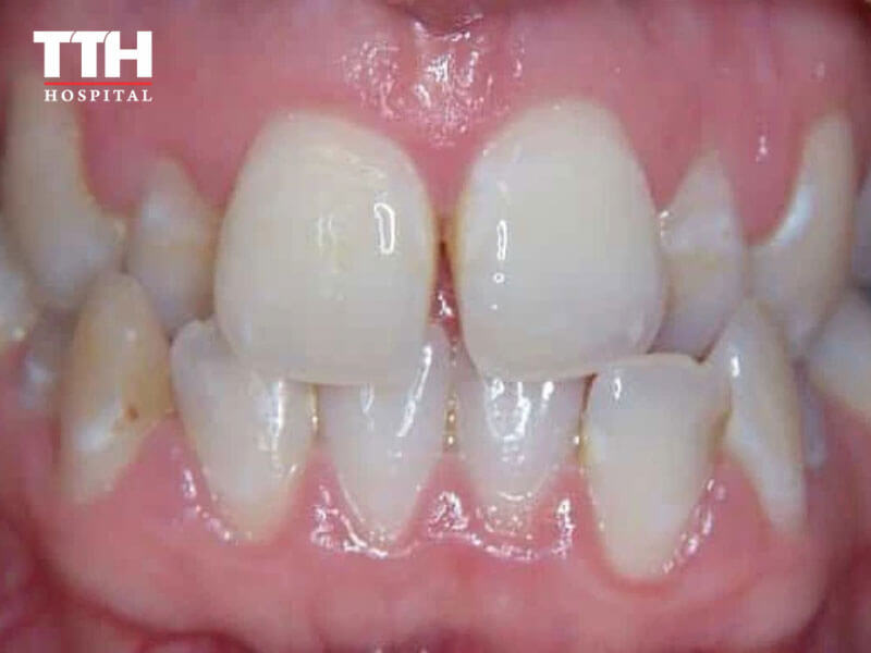 RĂNG CẮN CHÉO (CROSS BITE)