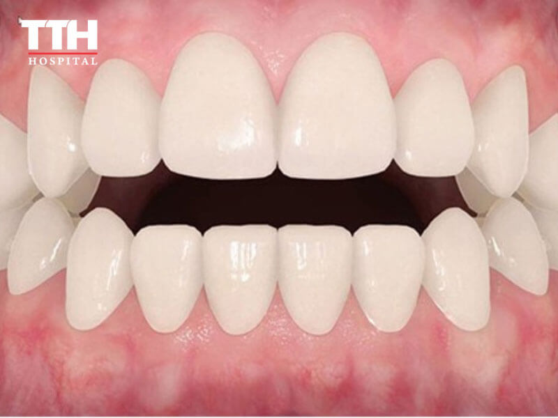 RĂNG CẮN HỞ (OPEN BITE)