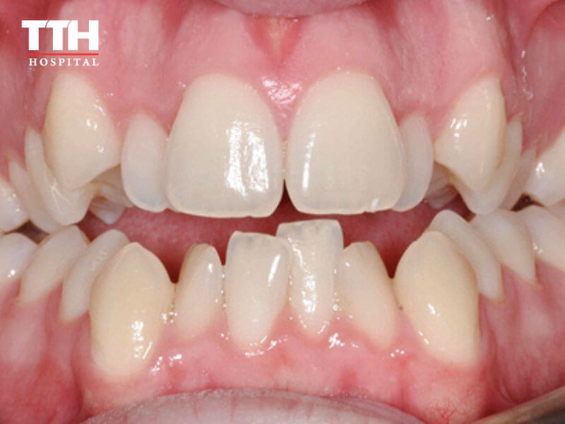 RĂNG CHEN CHÚC (CROWDED TEETH)