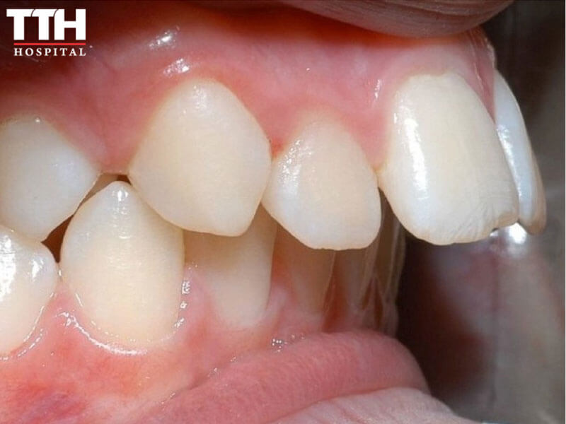 RĂNG HÔ (OVERBITE)