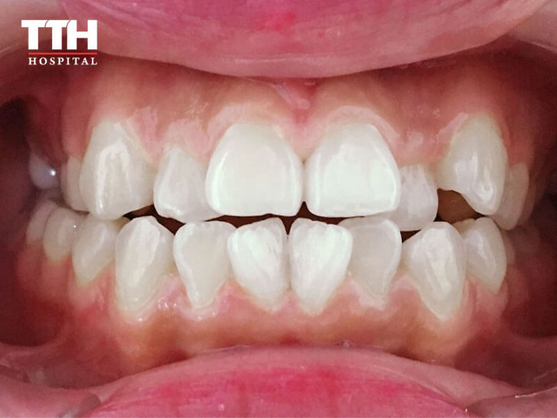 RĂNG KHẤP KHỂNH (CROOKED TEETH)