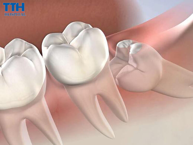 Răng khôn là gì?