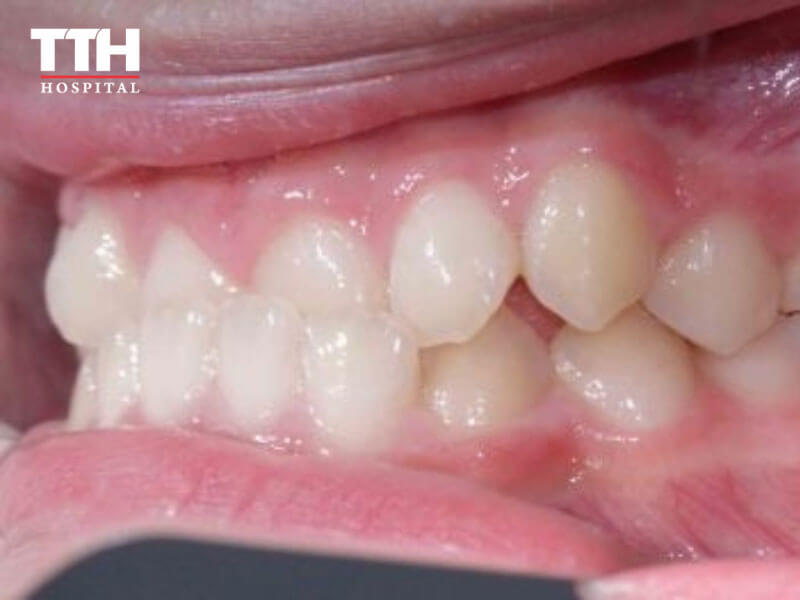 RĂNG MÓM (UNDERBITE)