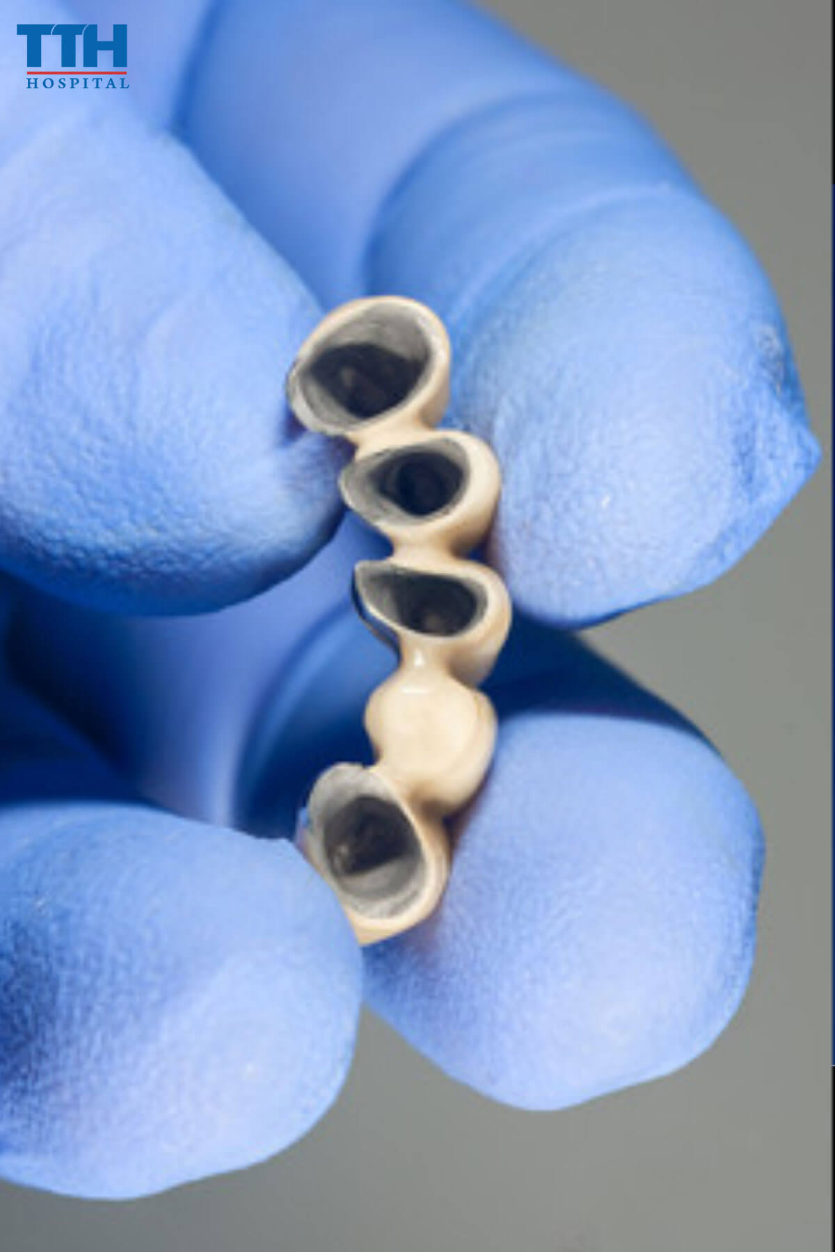 Răng sứ kim loại