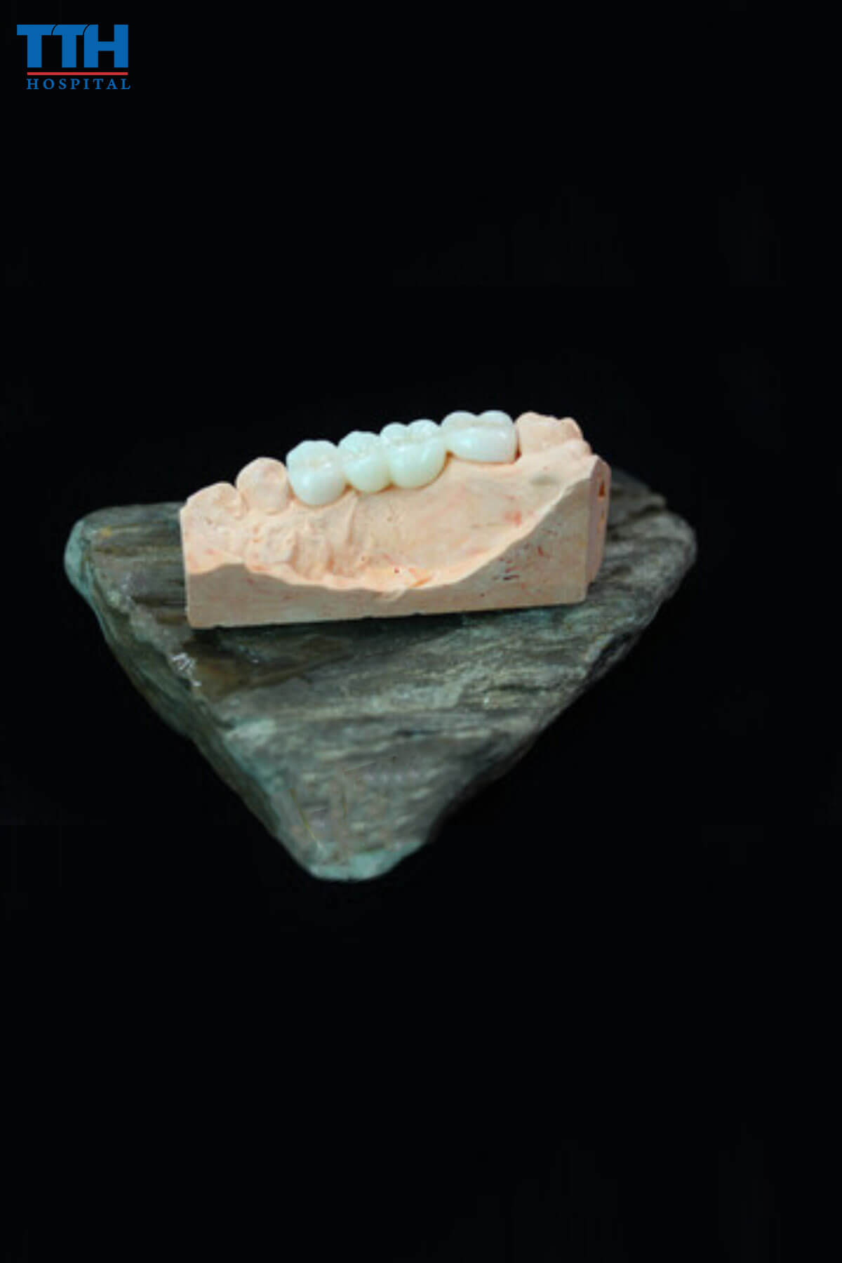 Răng Sứ Pha Lê tại Vinh, Nghệ An