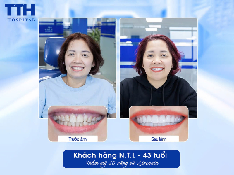 Răng sứ thẩm mỹ – Đầu tư cho nụ cười tự tin