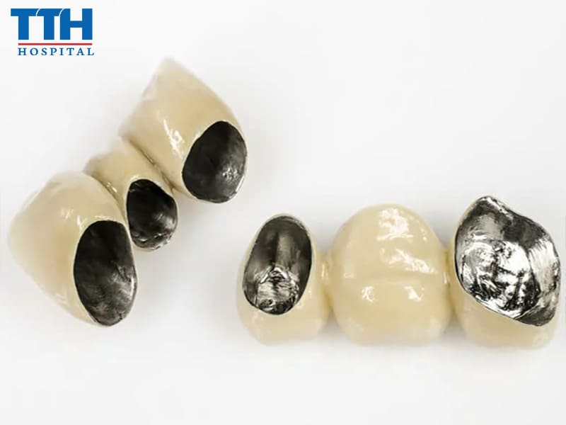 Răng Sứ Thường