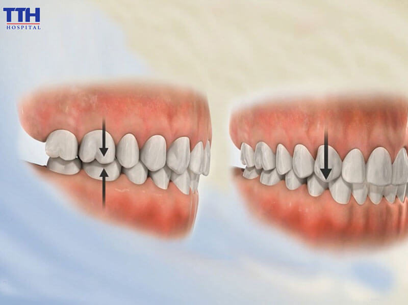 Răng xô lệch, sai khớp cắn, đau khớp thái dương hàm