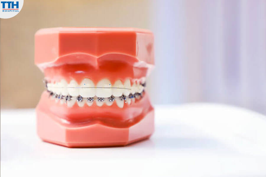 So Sánh Các Loại Niềng Răng Mắc Cài Tự Buộc