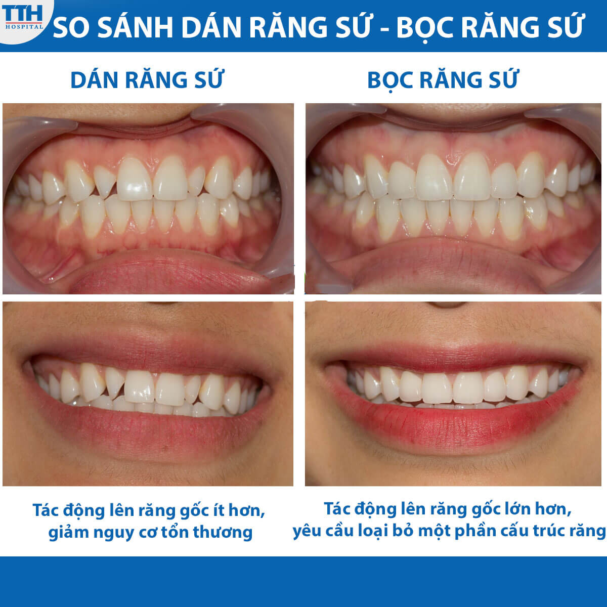 So sánh dán răng sứ và bọc răng sứ