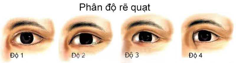 Phẫu thuật tạo khóe mắt là phương pháp thẩm mỹ giúp cải thiện vẻ đẹp