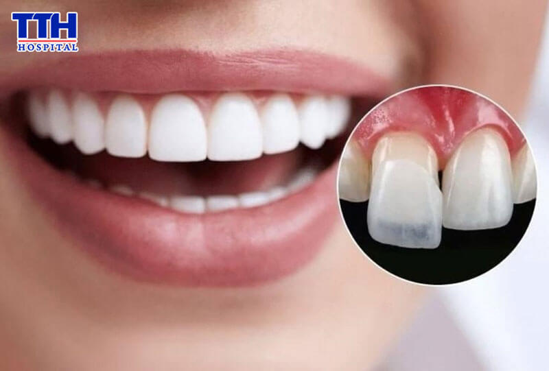 TẠI SAO DÁN SỨ VENEER TRỞ THÀNH XU HƯỚNG “THỐNG TRỊ” NĂM 2026?