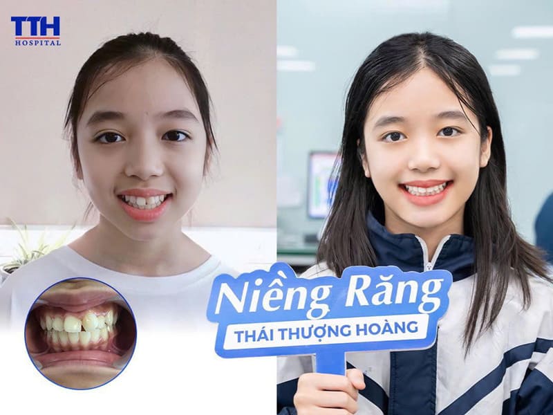 TẠI SAO HỌC SINH NÊN NIỀNG RĂNG SỚM?