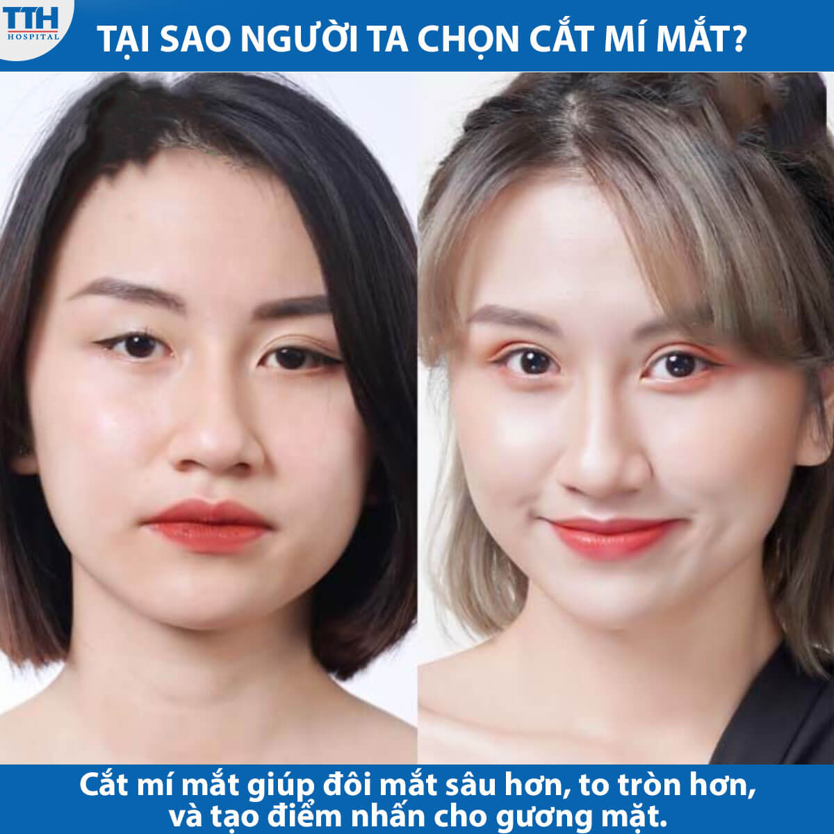 Tại Sao Người Ta Chọn Cắt Mí Mắt?