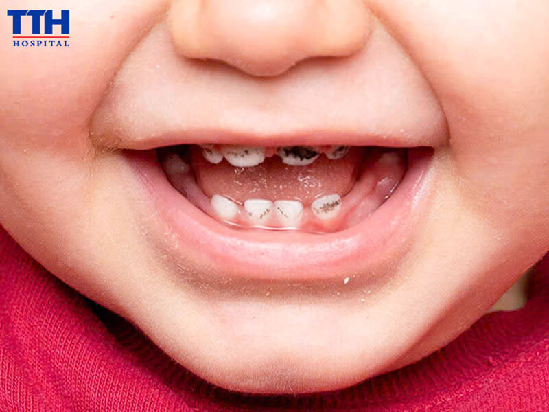 Tại sao việc chăm sóc răng miệng từ sớm cho trẻ lại quan trọng?