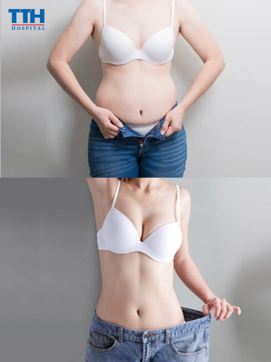 Tạo hình thành bụng là gì?