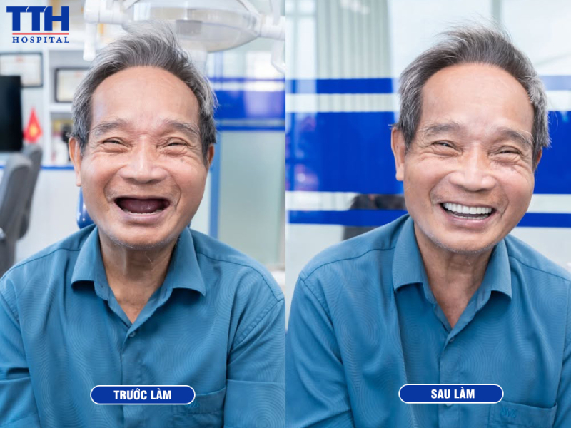 Thăm khám và tư vấn cấy ghép Implant tại Bệnh viện Răng Hàm Mặt & Phẫu thuật Thẩm mỹ Thái Thượng Hoàng