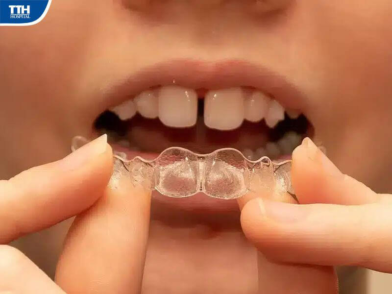 Thế nào là niềng răng trong suốt cho trẻ em?