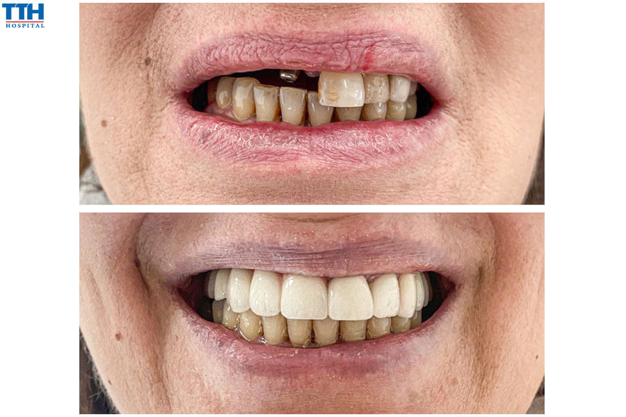 Thời gian hồi phục sau khi trồng răng implant