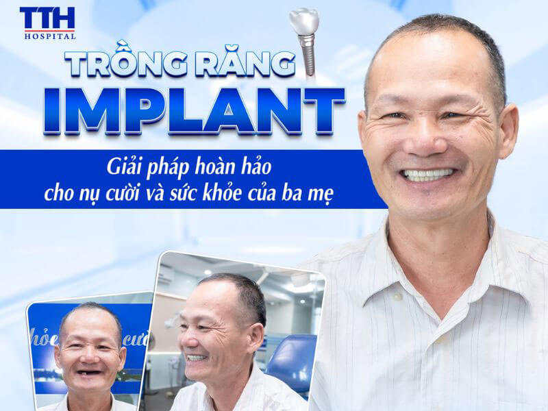 Tìm hiểu cấu tạo trụ Implant Nobel