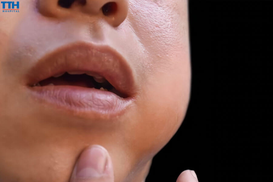 Triệu Chứng Của Áp Xe Tủy Răng